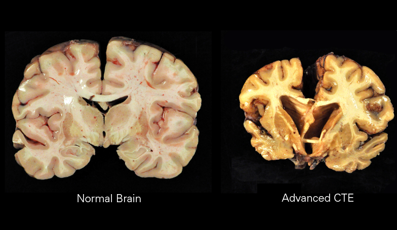 This is what a normal brain and a brain with advanced chronic traumatic encephalopathy look like. By Boston University Center for the Study of Traumatic Encephalopathy [CC BY-SA 4.0 (https://creativecommons.org/licenses/by-sa/4.0)], via Wikimedia Commons from Wikimedia Commons

